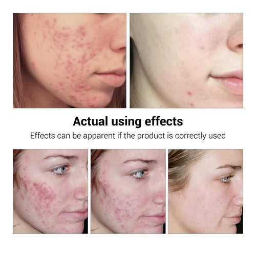 BREYLEE Acne & Scar Treatment Serum
